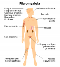 Burial Insurance with Fibromyalgia